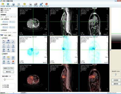 PET-CT-MR中心融合处理软件中文报告系统