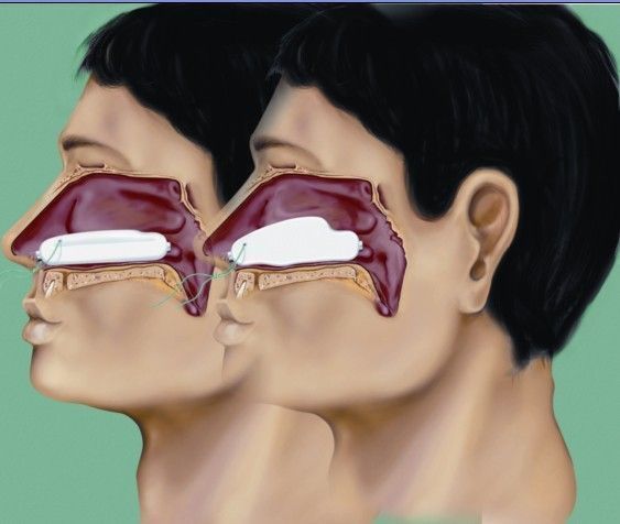 德国LR-科赛尔膨胀海绵鼻塞