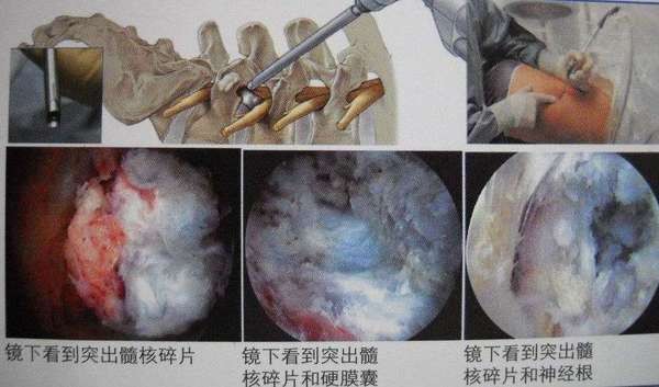 椎间孔镜