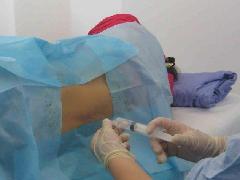 臭氧治疗椎间盘穿刺针,臭氧耗材