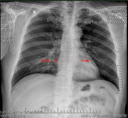 CR胸部医用胶片