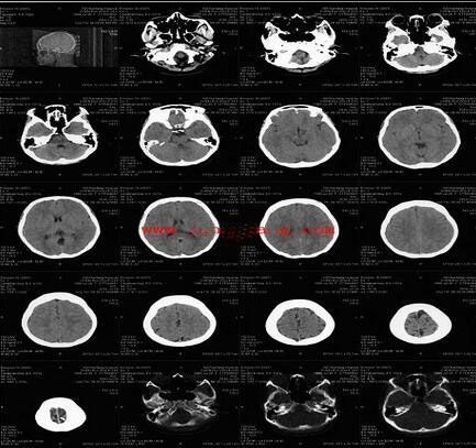 CT脑部医用胶片