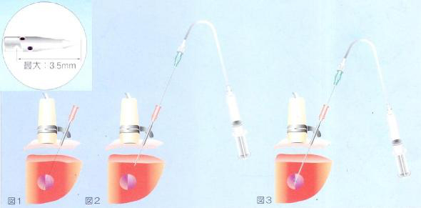 日本八光经皮酒精注射疗法针