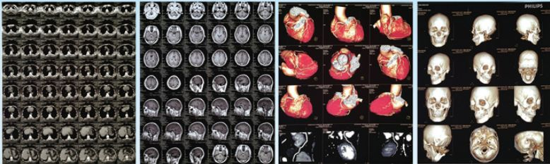 医用激光胶片/医用干式胶片