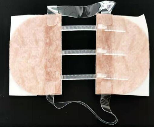 医用可调式无针皮肤缝合器