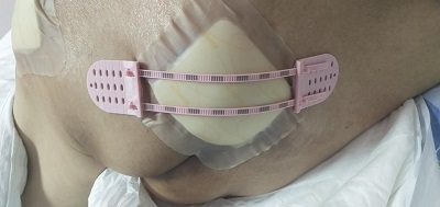 皮肤牵拉闭合器