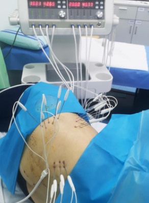 淄博前沿佳科K型内热针灸治疗仪 内热针理疗仪