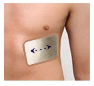 胸骨固定板(外科胸肋骨骨折手术外固定夹板)百达智美医学厂家招商