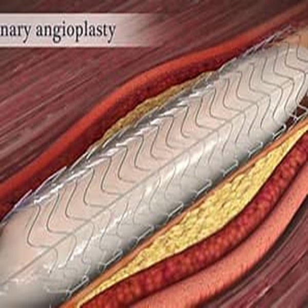 飞利浦外周刻痕球囊扩张导管