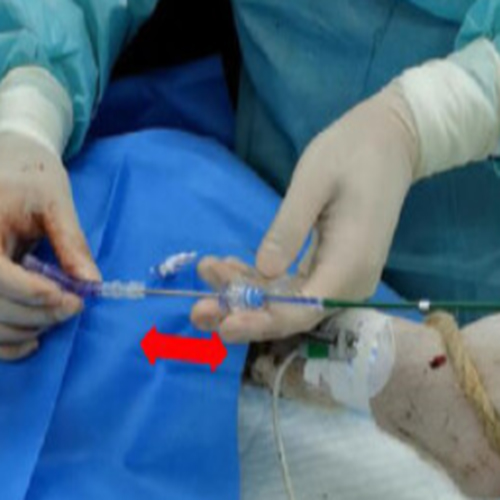 主动脉成型及阻断球囊导管(Aortic Molding and Occlusion Balloon